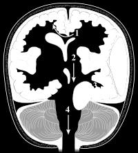 e tronco cerebral dentro do hiato tentorial; Herniação Subtentorial: aumento da pressão dentro da fossa posterior pode causar: