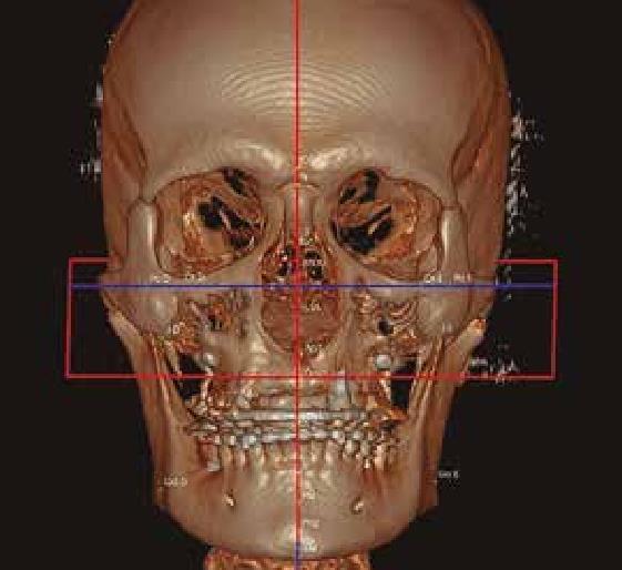 Módulo 04 Planeamento Reverso em Ortodontia Aplicação do set-up ortodôntico virtual juntamente com as tomografias na