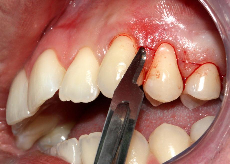 Foi traçado um plano de tratamento para o recobrimento radicular através de cirurgia de retalho de forma coronal, seguido de encaminhamento para a realização de tratamento ortodôntico, visando a não