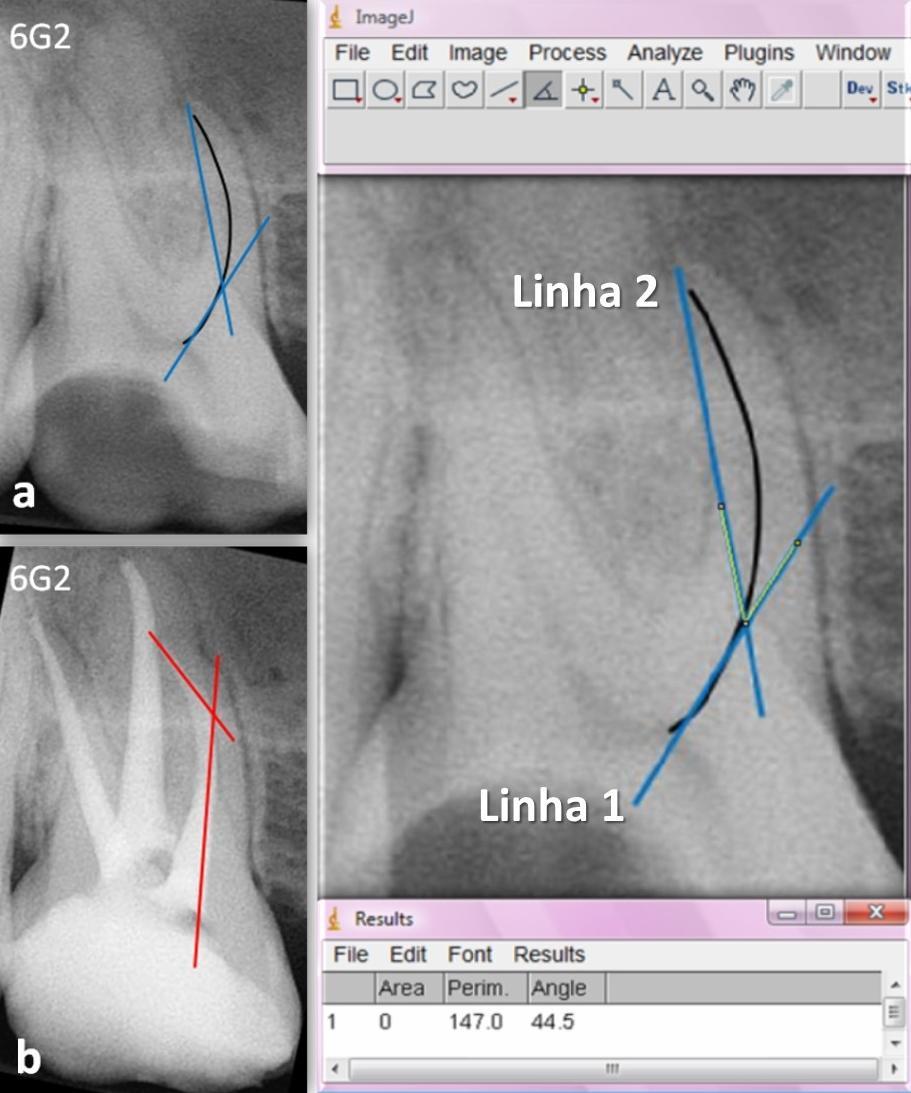 11 Figura 7 Linhas traçadas para localização do ângulo de curvatura: a. Antes e b. Após o tratamento endodôntico; c. Obtenção do ângulo no Image J.