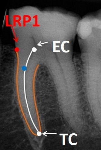 6 Limite Radicular Periodontal 1 (LRP1) - onde se localizava o ligamento periodontal na altura do início do trajeto radicular (Figura 2). Figura 2 Marcação dos pontos EC, TC e LRP1.