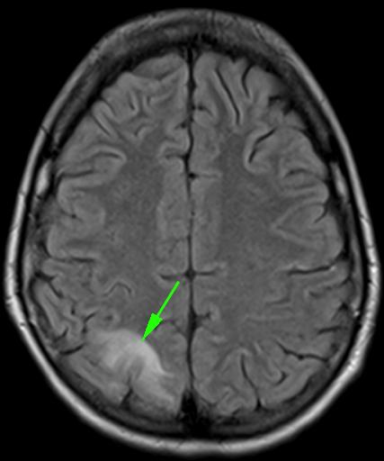 Resultados Fig. 1 Fig. 2 Fig. 3 Sequência crânio-caudal de imagens de RM axiais FLAIR (Fig.