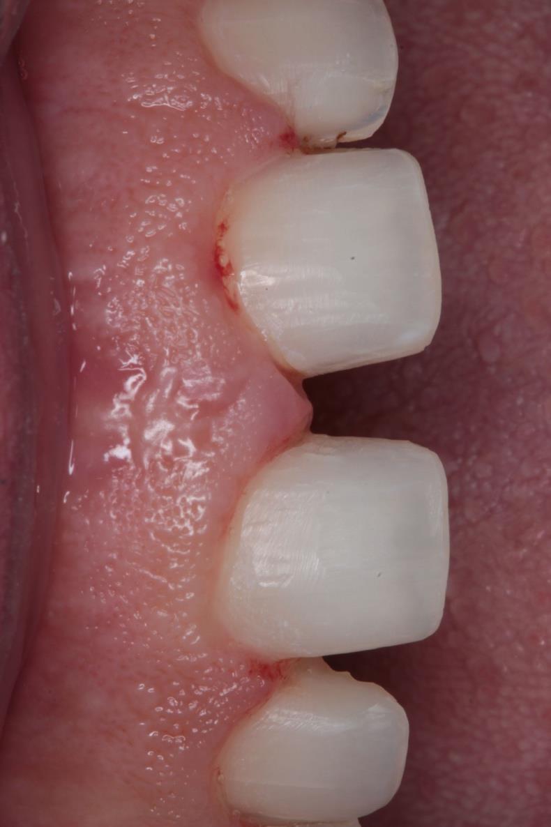 16 Figura 9 Preparo dos dentes. Figura 10 Visão aproximada do preparo após acabamento e polimento.