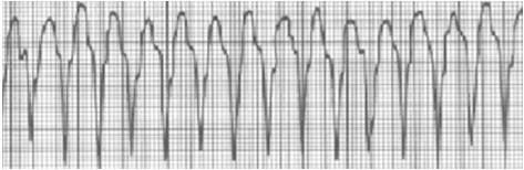 Taquicardia Ventricular sem