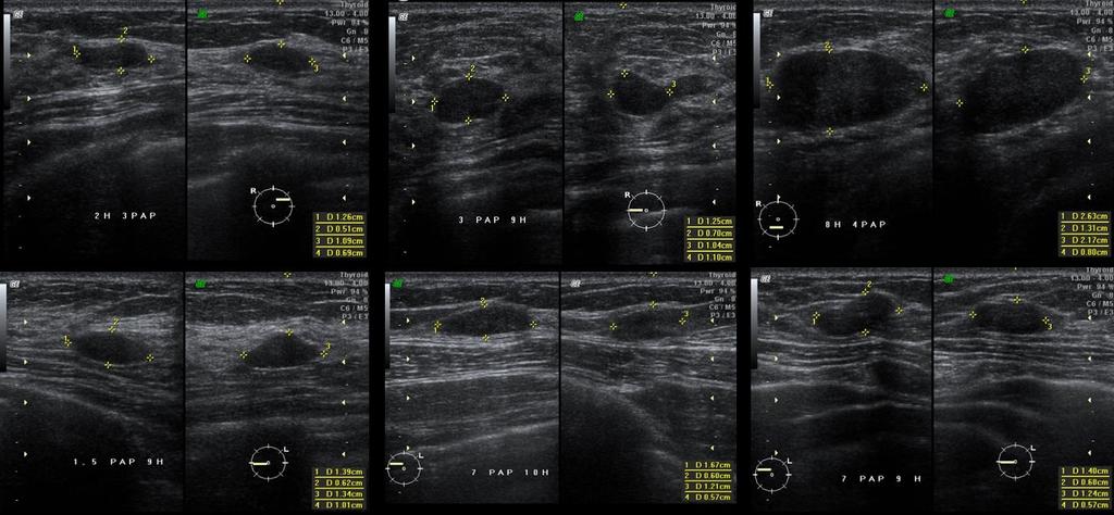 Múltiplos Nódulos Qual a mudança para múltiplos nódulos ao ultrassom?