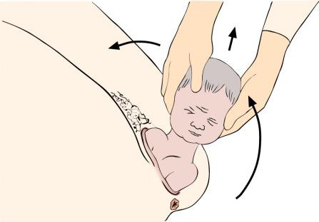 momento as espáduas de posicionam no diâmetro ântero-posterior, o ombro anterior se coloca sob o pube e o