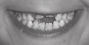 42 Boletim da Escola Item P3504BH Leia o texto abaixo. Por que os dentes de leite caem? Os dentes de leite caem para dar lugar aos dentes permanentes.