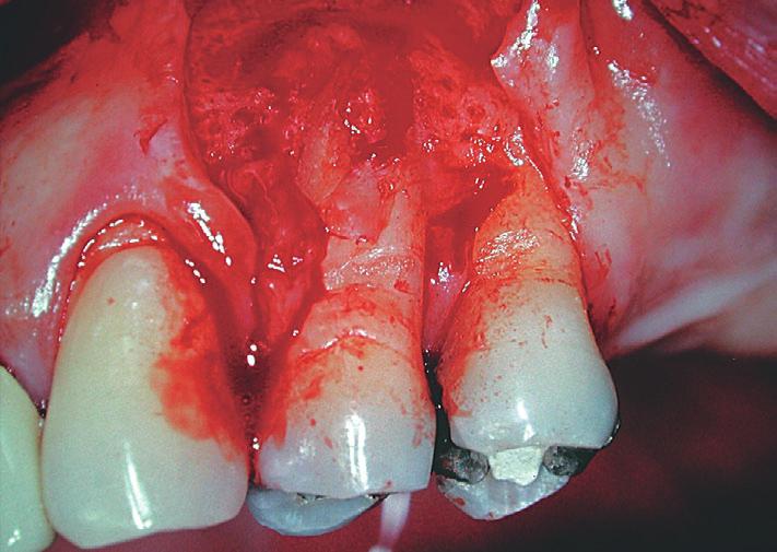 Após descolamento, foi possível observar que a extensão da perda óssea, provocada pela periodontopatia, compreendia toda a parede vestibular do alvéolo