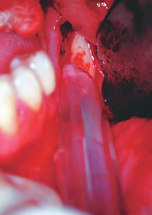 RELATO DE CASO CLÍNICO Figura 4 Remanescente ósseo alveolar após curetagem. Figura 1 Aspecto clínico inicial.