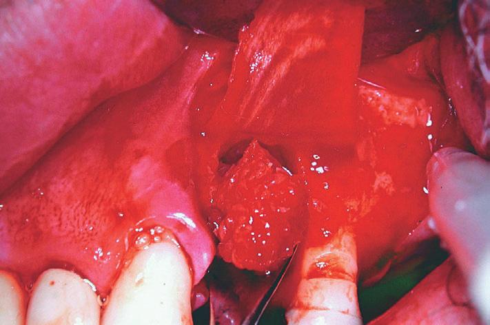 (Autogenous â ) foram obtidas raspas de osso cortical mandibular em quantidade suficiente para preenchimento do defeito (Figuras 5 e 6).