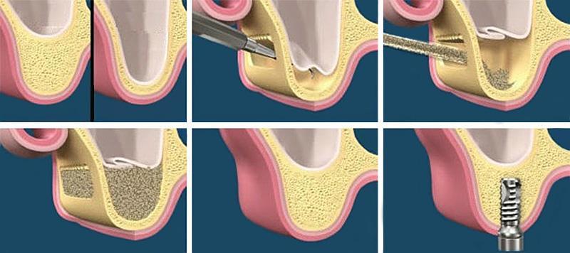 5.3 LEVANTAMENTO DE SEIO MAXILAR A reabilitação da maxila posterior edêntula com implantes é um desafio para o cirurgião, devido ao volume ósseo insuficiente produzido pela atrofia da crista e do