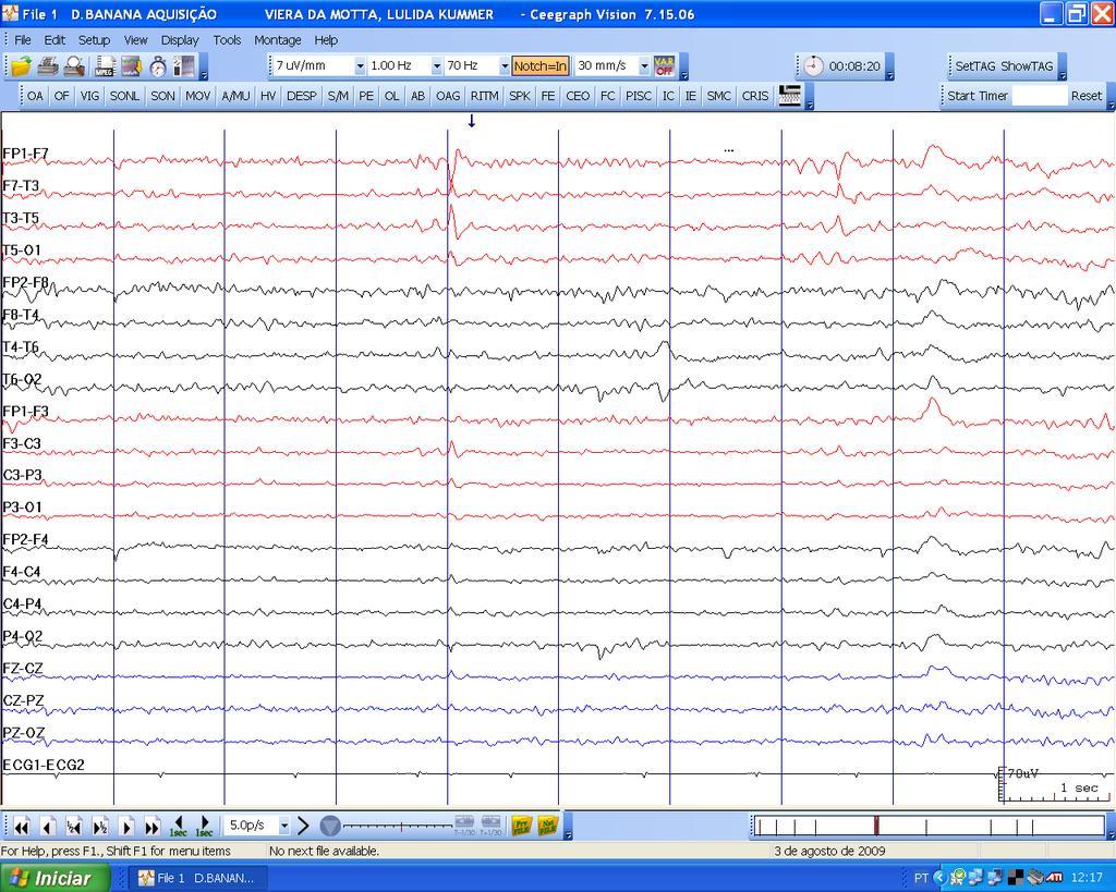 Wicket spikes x ondas agudas PADRÕES DE