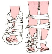 Imobilização de uma perna ou coxa No caso de lesões nas pernas, se não tiver uma tábua comprida que