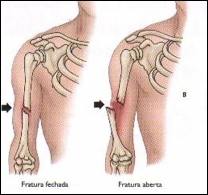 Fraturas CLASSIFICAÇÃO Significa osso quebrado Fechada: pele intacta