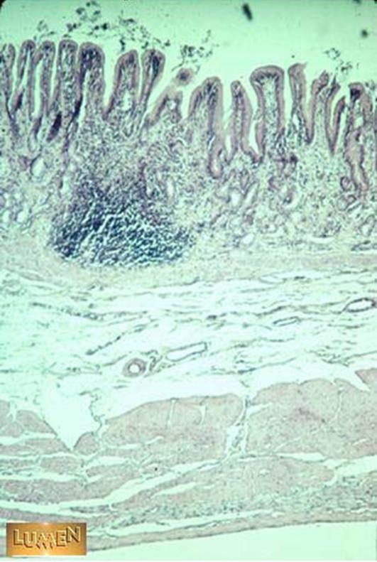 MALT: organização estrutural Coleções frouxas de tecido linfoide Ex: lâmina