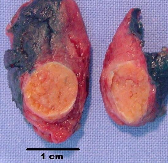 Carcinoma