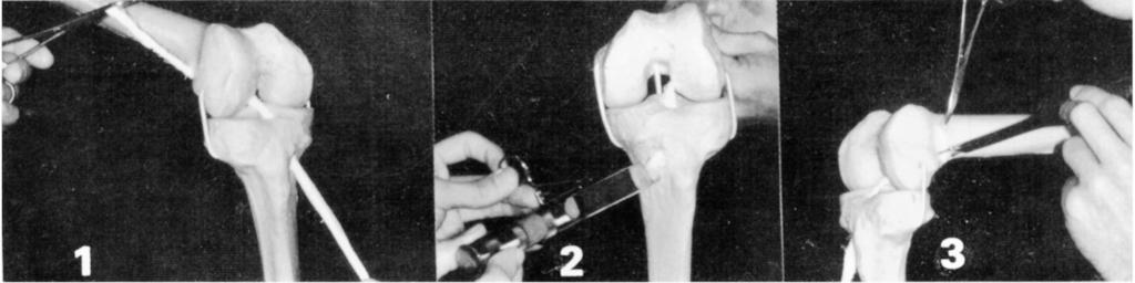 J.M. BARRETTO Seqüência 4 1) Escolha do ponto isométrico femoral com probe. 2) Fio-guia cruzando o intercôndilo e penetrando no côndilo femoral lateral.