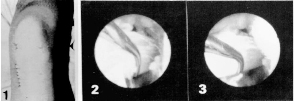 6) Visão artroscópica do furo femoral. Seqüência 5-1) Representação esquemática de passagem do tendão pelos furos tibial e femoral. 2) Fixação com grampos de Blount na tíbia.