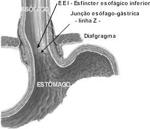 DOENÇA DO REFLUXO GASTROESOFÁGICO DRGE DOENÇA DO REFLUXO