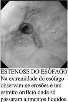 conteúdo gastroduodenal para o esôfago e/ou órgãos adjacentes a ele,