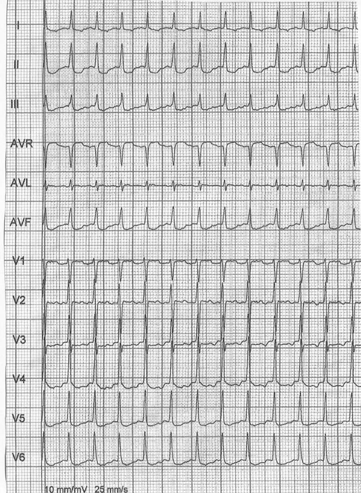 Observe o caso clínico e eletrocardiograma abaixo, para responder às questões 31 e 32.