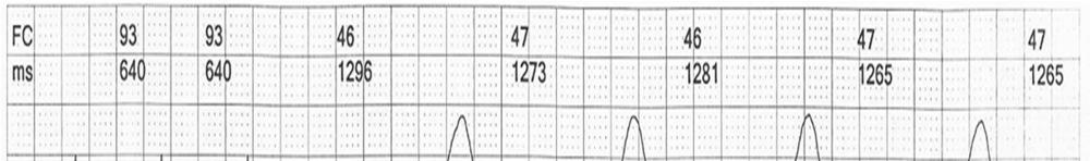 37. A resposta mais esperada com o uso de adenosina endovenosa (12 mg) em um paciente com flutter atrial com condução atriventricular 2:1 é: a reversão a ritmo sinusal b transformação em ritmo de