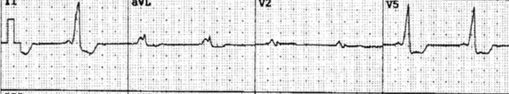 No traçado eletrocardiográfico a seguir (reprodução de traçados originalmente em papel milimetrado à velocidade de 25mm/s), é correto afirmar que existe: 47.