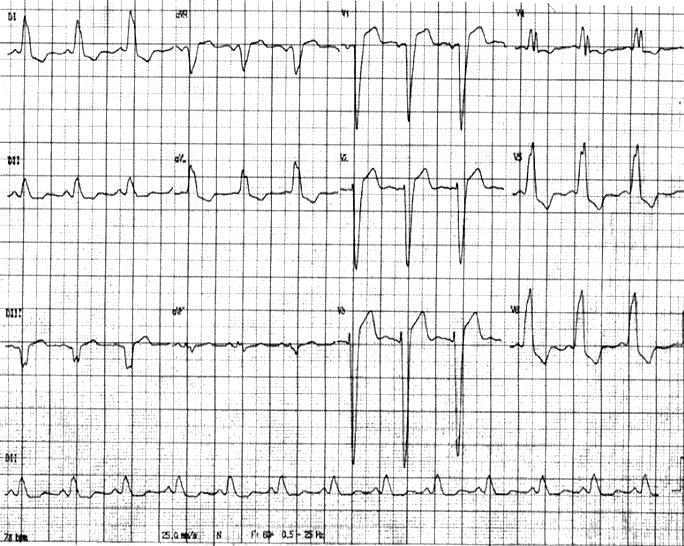 No traçado eletrocardiográfico a seguir (reprodução de traçados originalmente em papel milimetrado à velocidade de 25mm/s), é correto afirmar que existe: a bloqueio de ramo