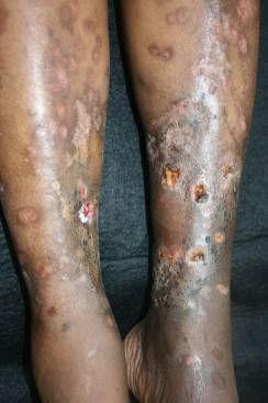 SARCOIDOSE Exame dermatológico: Lesões