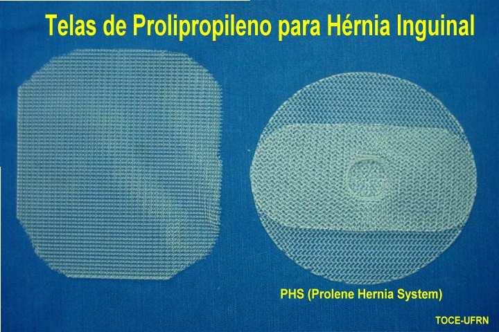 Telas para Cirurgia de Hérnia Inguinal Fios de