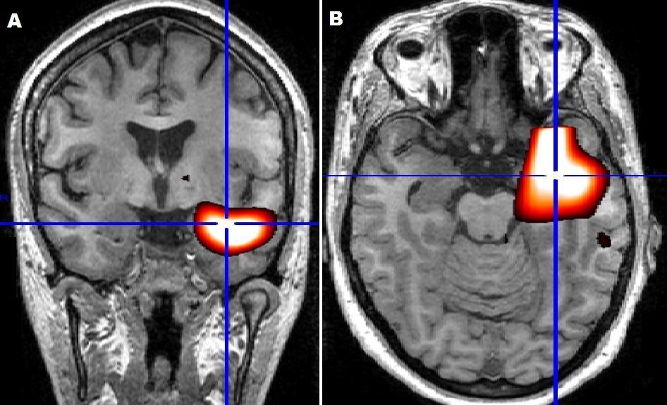 Figura 2 - SISCOM coronal e axial (A e B, respectivamente) de paciente com epilepsia de lobo temporal à direita.