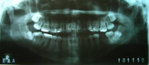 19. A drenagem espontânea de uma fístula extra-oral pode deixar cicatriz significante 20.
