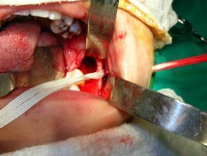 Cisto Dentígero Associado à Fístula Cutânea Relato de Caso até não ser mais observado remanescente da cápsula.