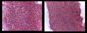 intraepitelial (até 35 eosinófilos / campo de