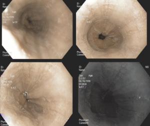 Histologia: Biópsia esofágica médio e proximal: esofagite