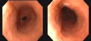 Histologia: Biópsia esofágica médio e proximal: esofagite crônica inespecífica. Ausência de eosinófilos neste material.