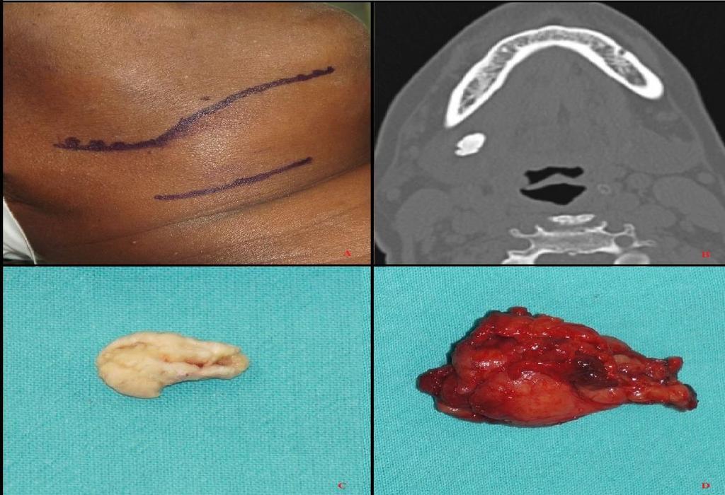 Fig.3: A - Marcação do bordo inferior da mandíbula e linha de incisão; B -Exame tomográfico demonstrando posicionamento e tamanho