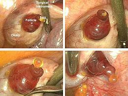 Jacques Donnez Laparoscopic observation of