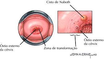 Colo do Útero Membrana mucosa Endocérvice Recobre a porção uterina Epitélio simples