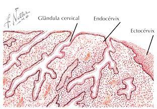 Ectocérvice -Cisto de Naboth: natureza folicular, originária de glândulas ocluídas e