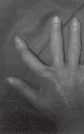 DISCUSSÃO As perdas cutâneas devem receber especial atenção no tratamento da mão traumatizada, pois sabemos que, para a TABELA 4 Freqüência e proporção da avaliação da cobertura do retalho Freqüência