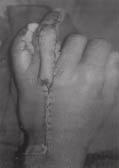 do retalho e do mesmo dedo contralateral nos casos do retalho baseado na primeira artéria metacarpal dorsal Nº TAM do TAM do Percentagem de segundo segundo movimentação dedo dedo ativa doador