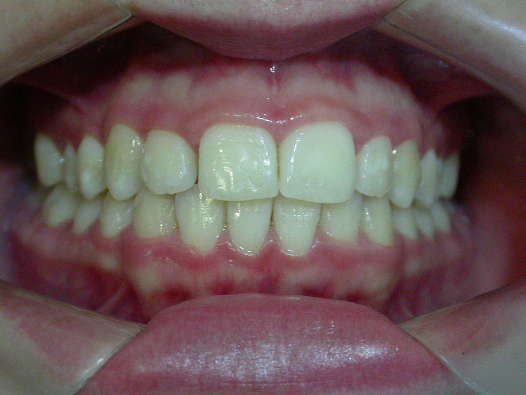 dentes, que podem ser de três formas (quadrada ou retangular, triangular e oval); e o formato da estrutura facial.