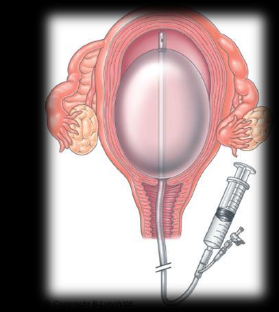 INTRAUTERINO TRAJE