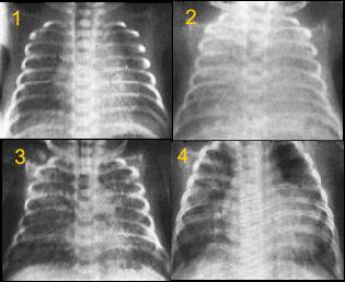 DISPLASIA BRONCOPULMONAR Histórico: Northway et al.