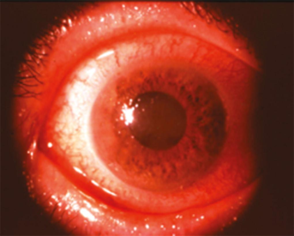 Fig. 6 : Olho com encerramento agudo do ângulo: edema corneano epitelial, câmara anterior muito baixa, midríase média e hiperemia ciliar muito acentuada.