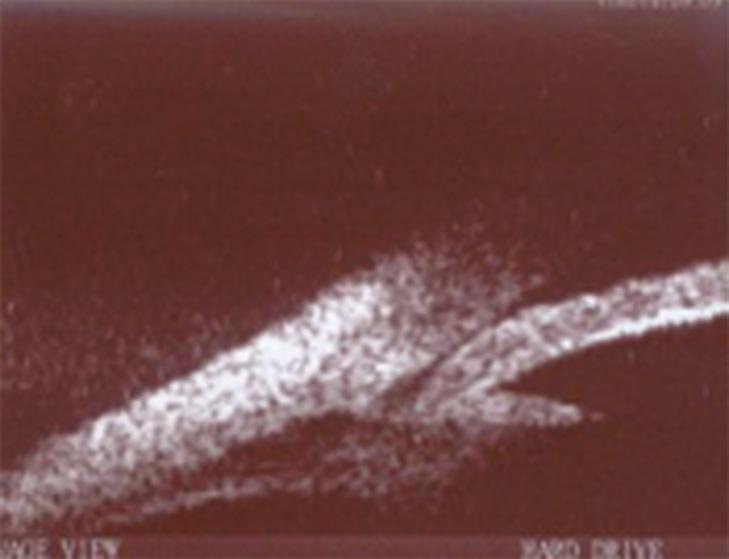 Foi realizada Ultrassonografia Biomicroscópica (UBM) que confirmou a presença de angulo estreito