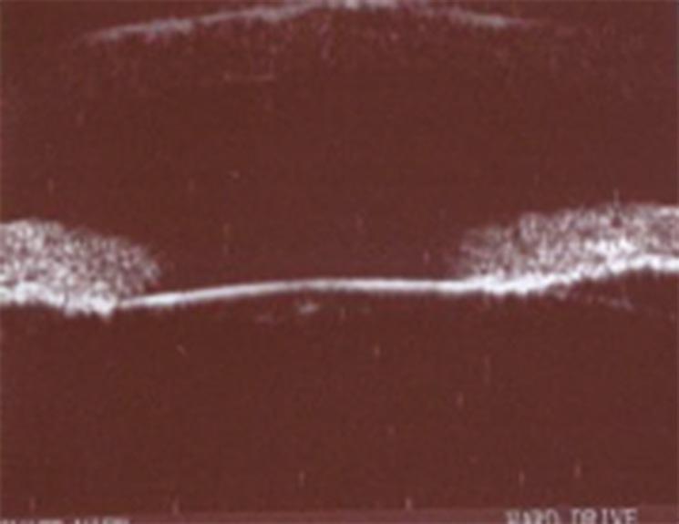 8). Fig. 8 Ultrassonografia biomicroscópica ODE (Realizada no Instituto Oftamológico Dr.