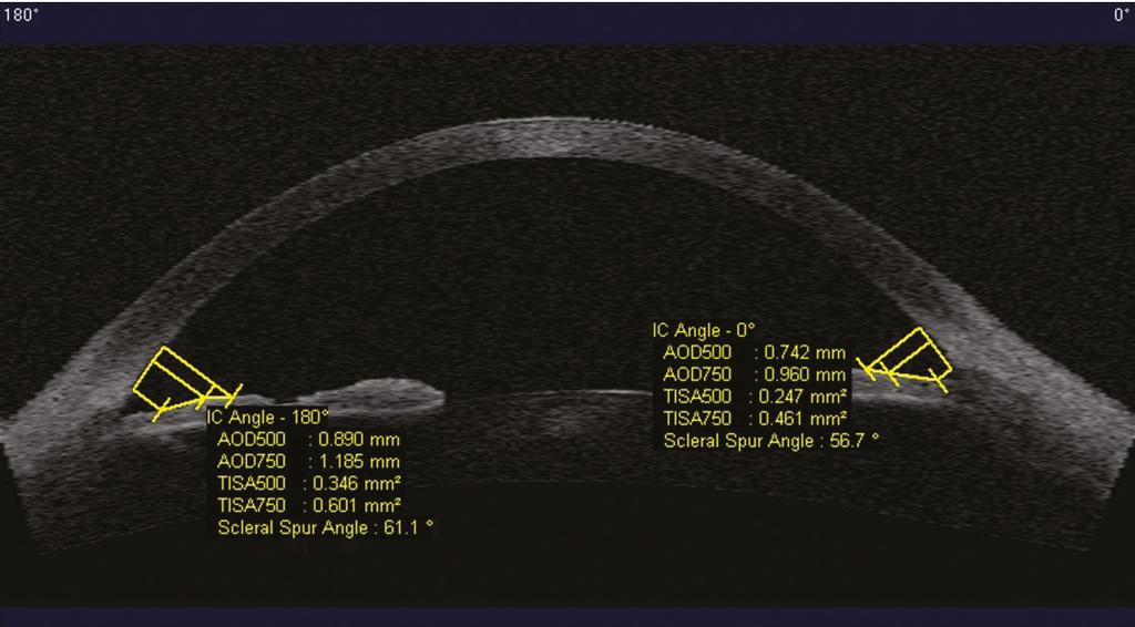 Fig. 2a (AS- OCT): Parâmetros Biometricos com base no esporão escleral AOD: distância da abertura angular medida às 500 micra (AOD 500) e às 750 micra(aod750); TISA: área da superfície