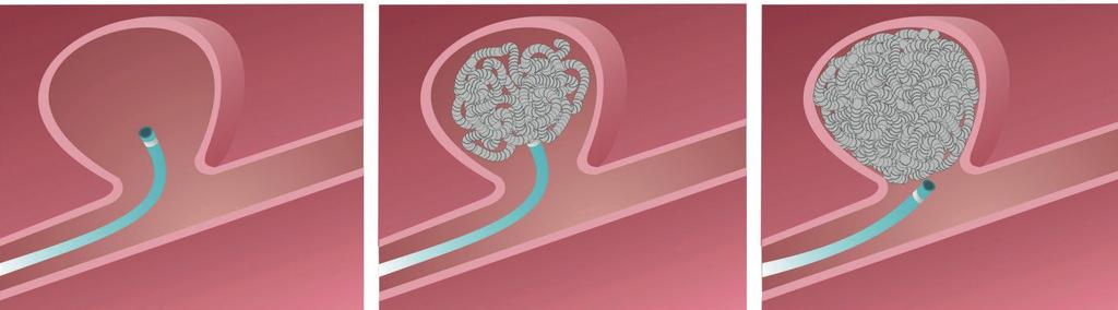 Thiago Giansante Abud ACIDENTE VASCULAR CEREBRAL Hemorrágico